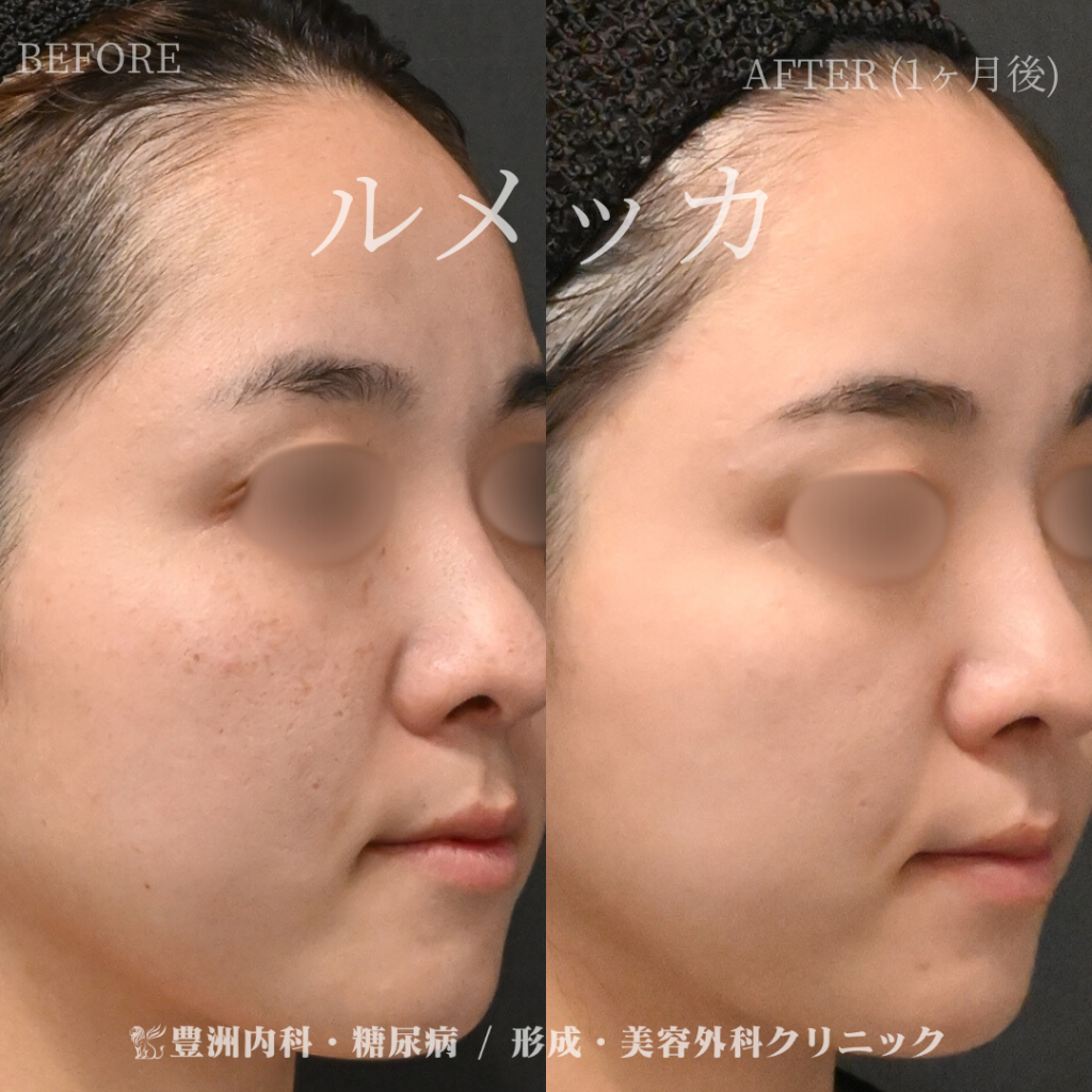 ルメッカ / 20代女性